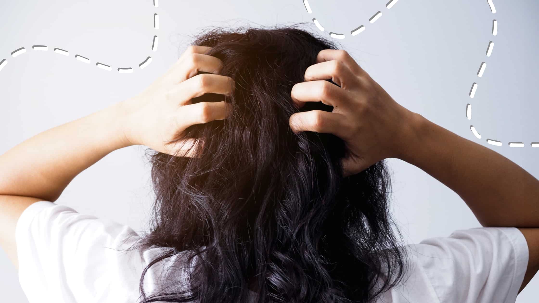woman with oily scalp suffering with dandruff